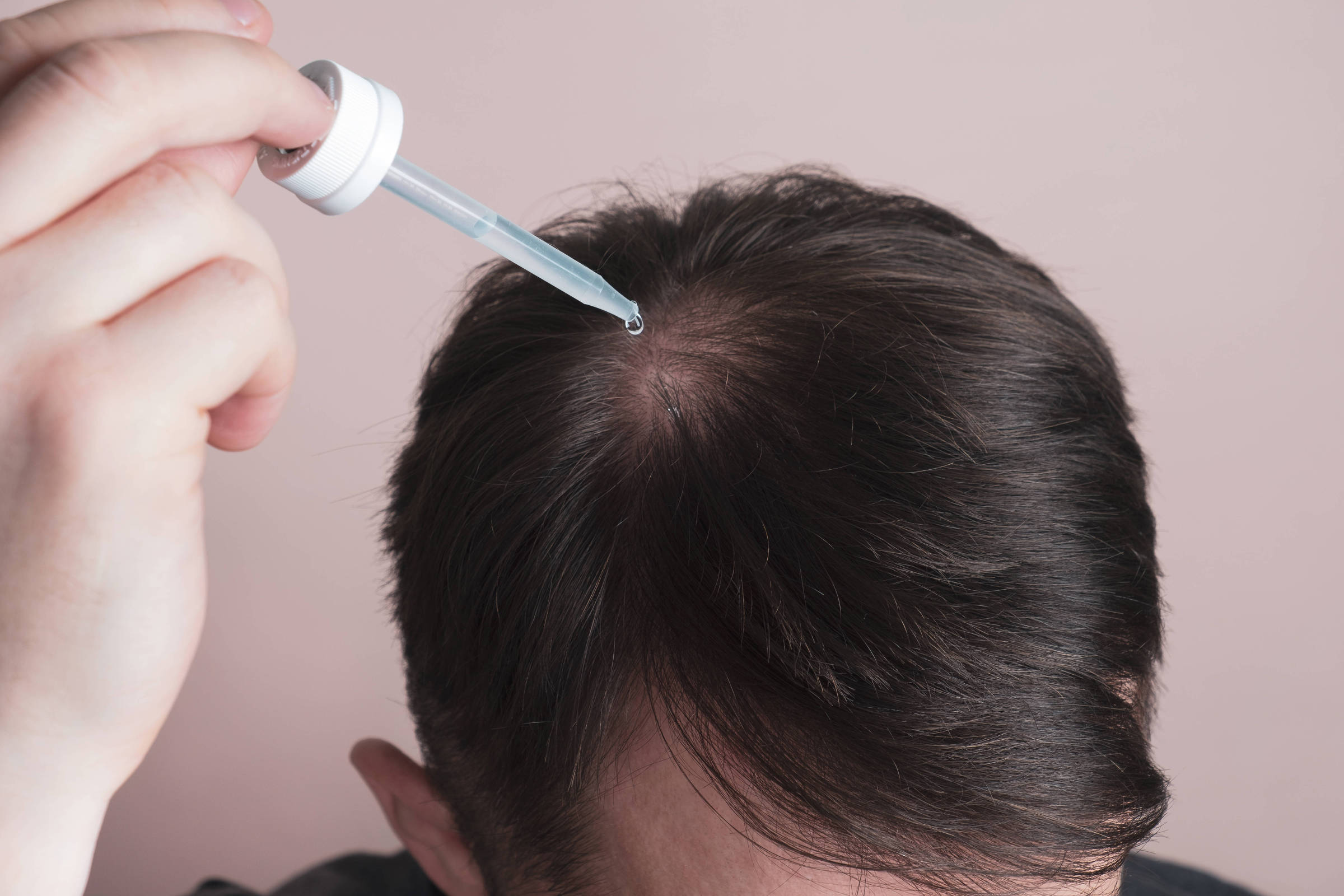 Minoxidil: Entenda por que o uso do medicamento para calvície é controverso entre especialistas